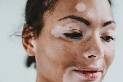 vitiligo tratamento